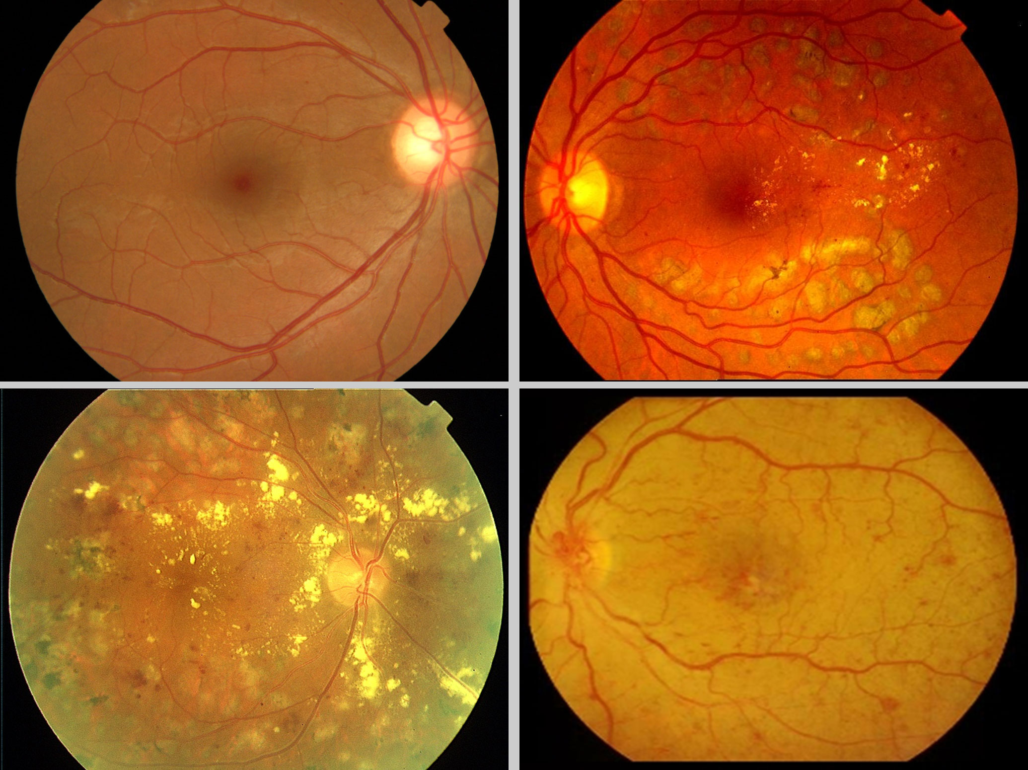 Лечение дегенерации макулы. Макулярная дистрофия сетчатки. Диабетическая ретинопатия глаз. Дегенерация центральной сетчатки глаза. Мелкокистозная дистрофия сетчатки.